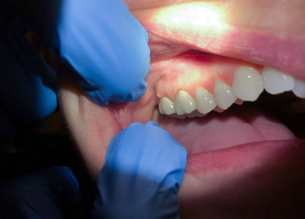 Best Emergency Tooth Extraction in China, TX